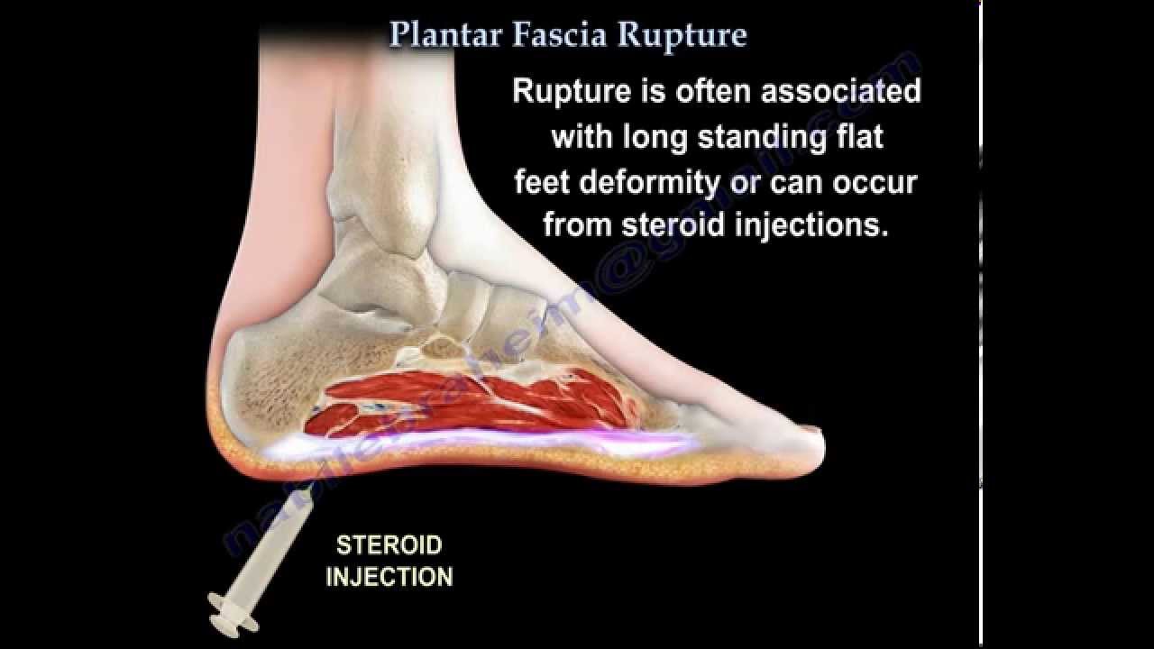 Partial Ligament Tear In Foot